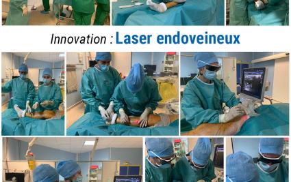 laser endoveineux